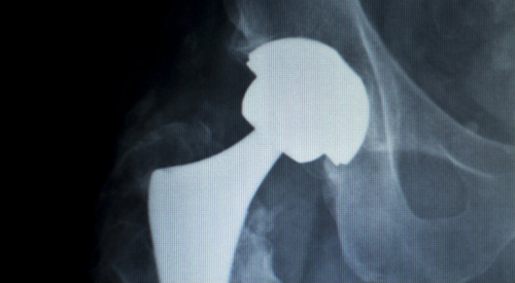 Texas Jury Awards $247 Million in Pinnacle Metal-on-Metal Hip Trial