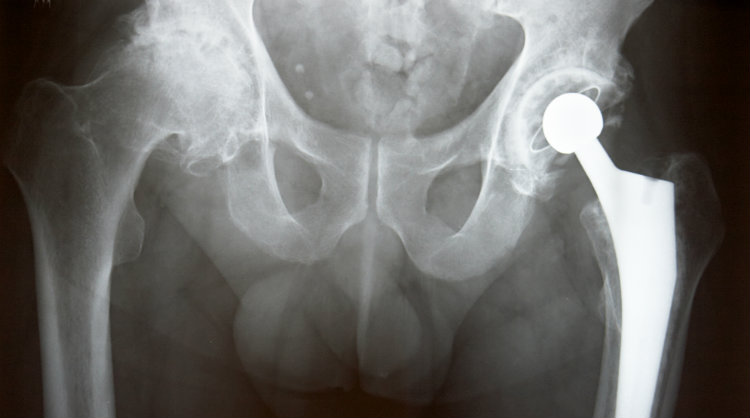 Biomet Faces More Magnum Hip Replacement Lawsuits