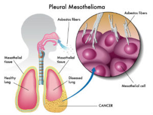 Pleural Mesothelioma cancer
