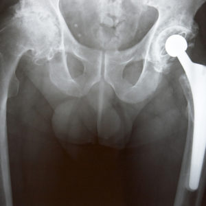 Exactech GXL Hip Implant Exactech GXL Hip Implant Hip Implant premature wear