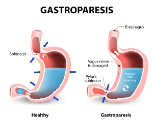 gastroparesis stomach paralysis failed to warn
